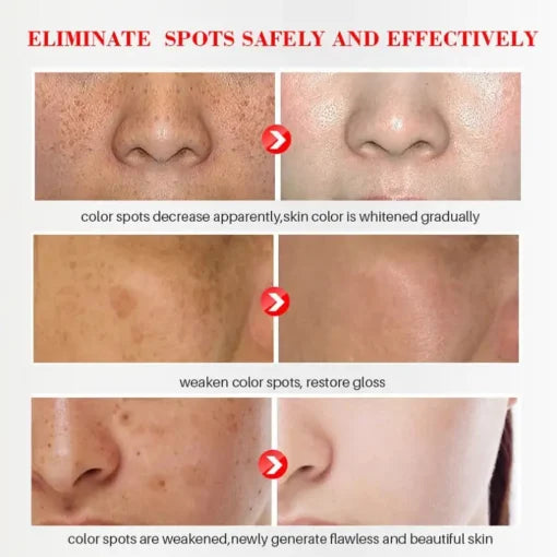 LUNOON™ Blemish Removing Beauty Cream