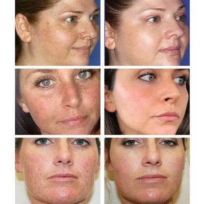LUNOON™ Blemish Removing Beauty Cream