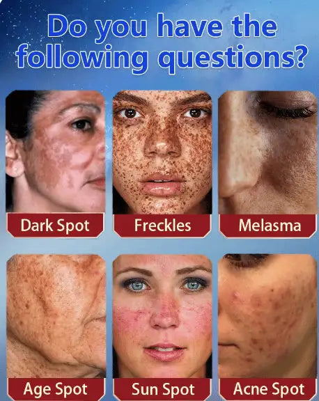 LUNOON™ Blemish Removing Beauty Cream