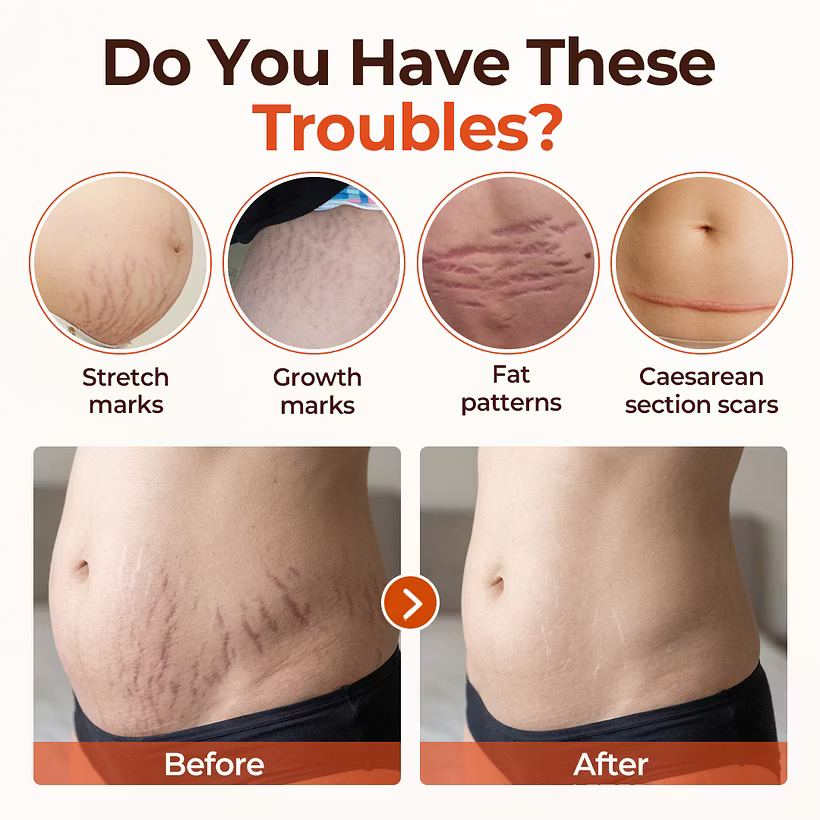 Biancat® SilkStretch Natural Stretch Mark & Scar Oil