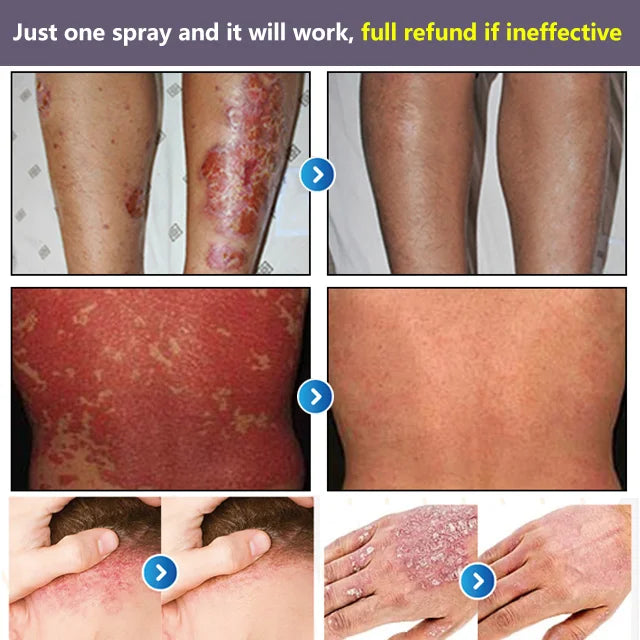South Moon® PsoriaMucin No-Rub Itch & Flake Relief Mist