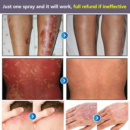 South Moon® PsoriaMucin No-Rub Itch & Flake Relief Mist
