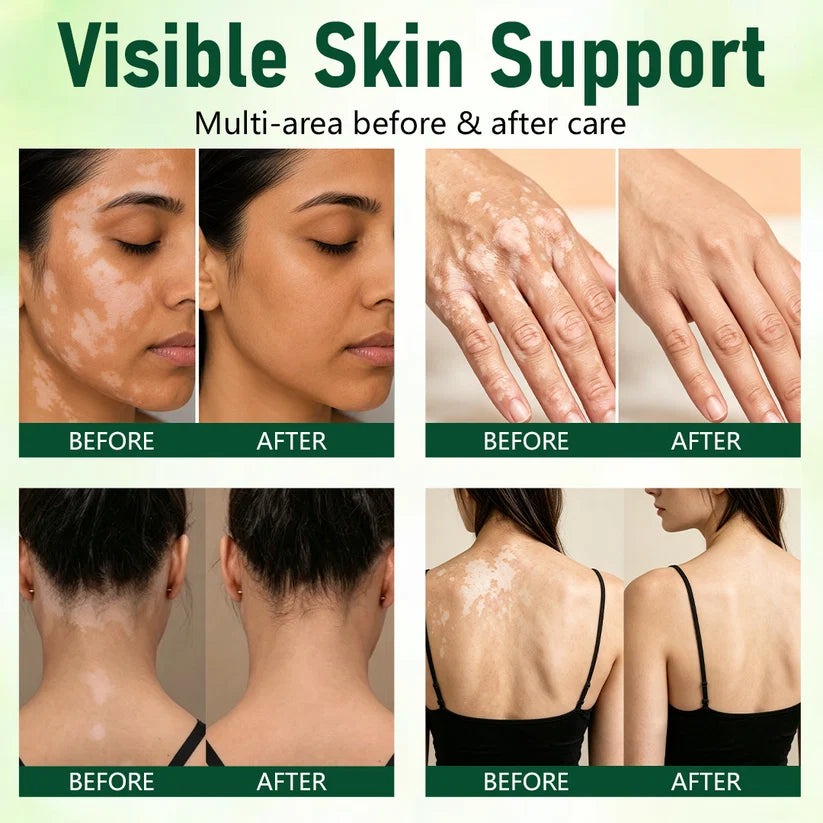 Ceoerty® Herbal Vitiligo Cream