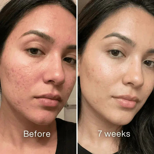 Clinical Acne Scar Repair Stick™