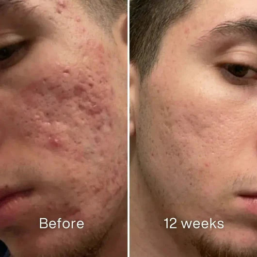 Clinical Acne Scar Repair Stick™