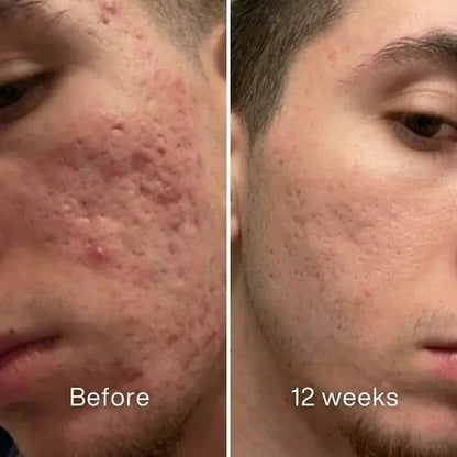Clinical Acne Scar Repair Stick™