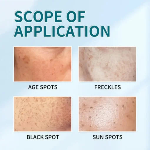 LUNOON™ Blemish Removing Beauty Cream